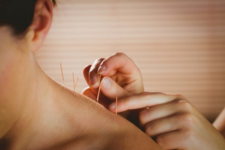The Benefits of Combining Acupuncture and Physical Therapy