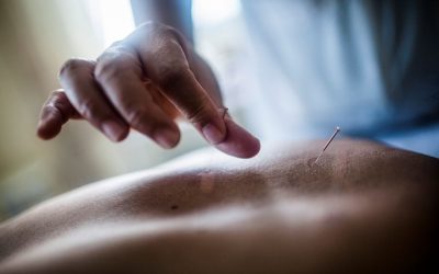 Benefits of Acupuncture for Stress and Pain