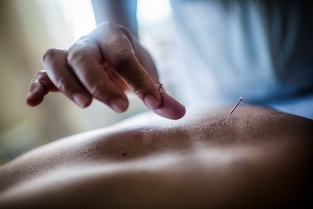 Benefits of Acupuncture for Stress and Pain