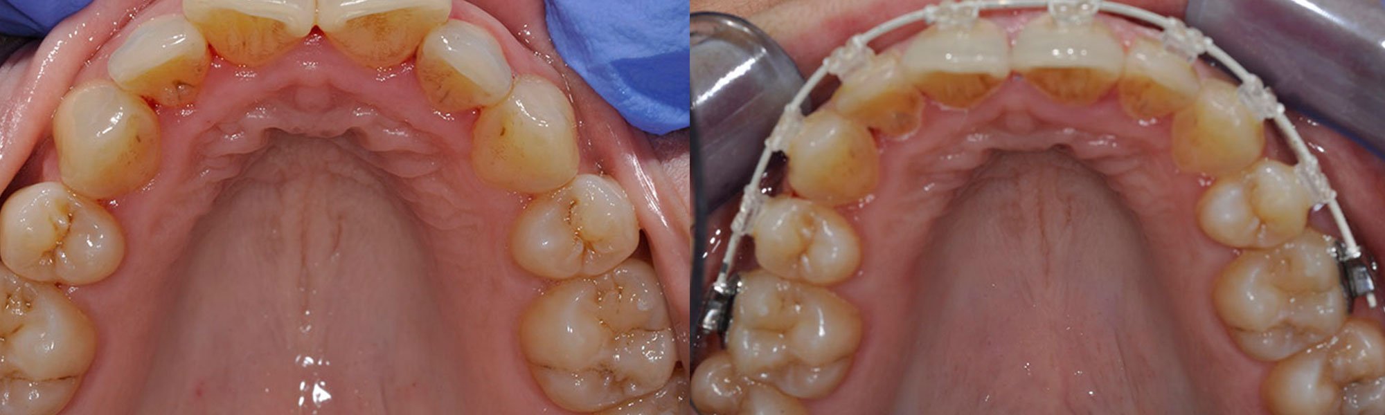 UPPER &#038; LOWER SIMPLY SMILE BRACES