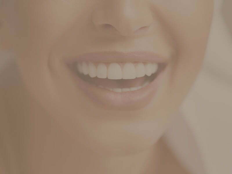 Veneers