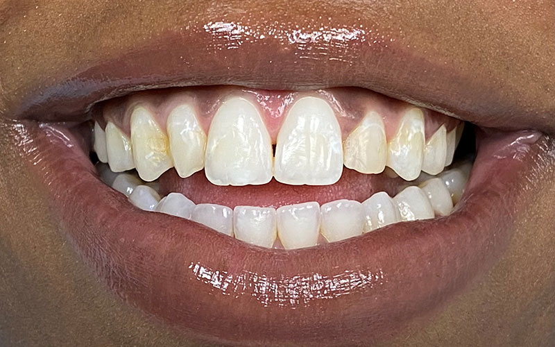 Veneer &#038; Composite Bonding Smile Gallery