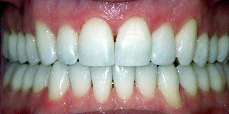 14-Invisalign-Composite-Bonding-After