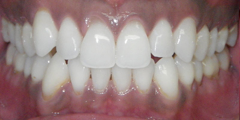 18-Invisalign-After-final