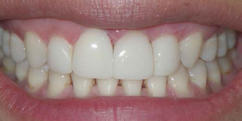 2-Invisalign-Composite-Bonding-After