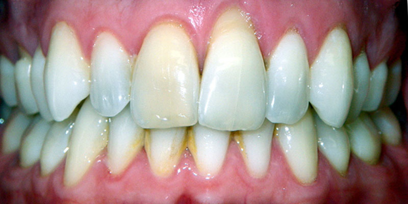 17-Invisalign-Before-final