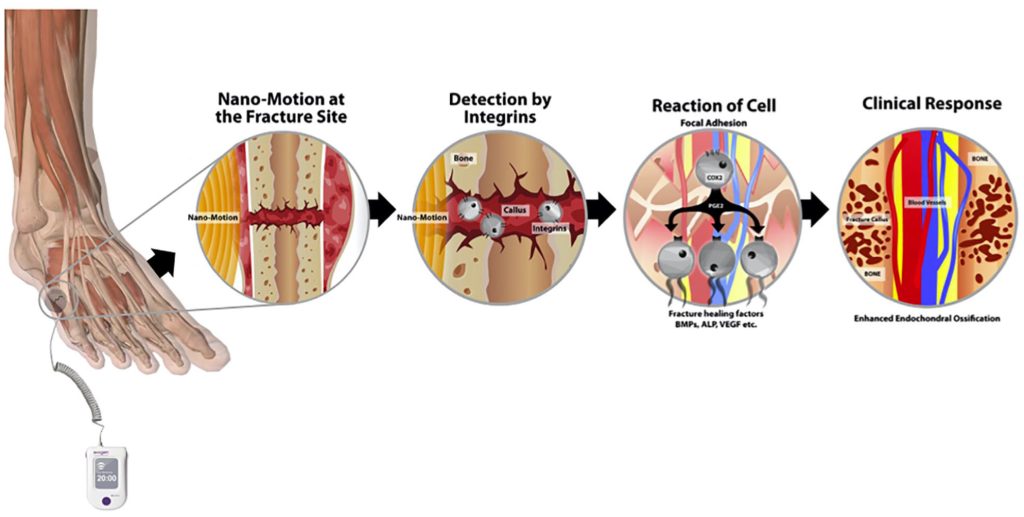 Exogen Bone Fracture Healing in the UK (Consultations from £95)