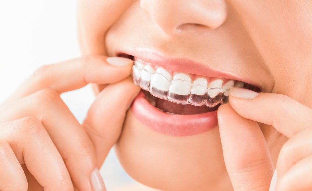 Invisalign Tandläkare Borås