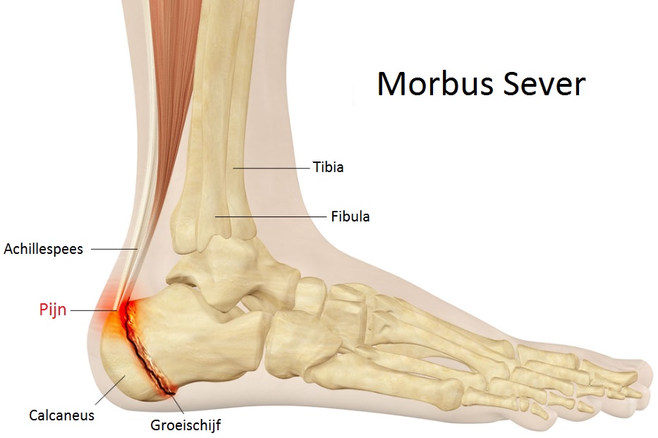 Morbus Sever (Hielpijn bij kinderen) - Podotherapie Holthuis