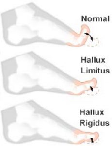 hallux-limitus-rigidus