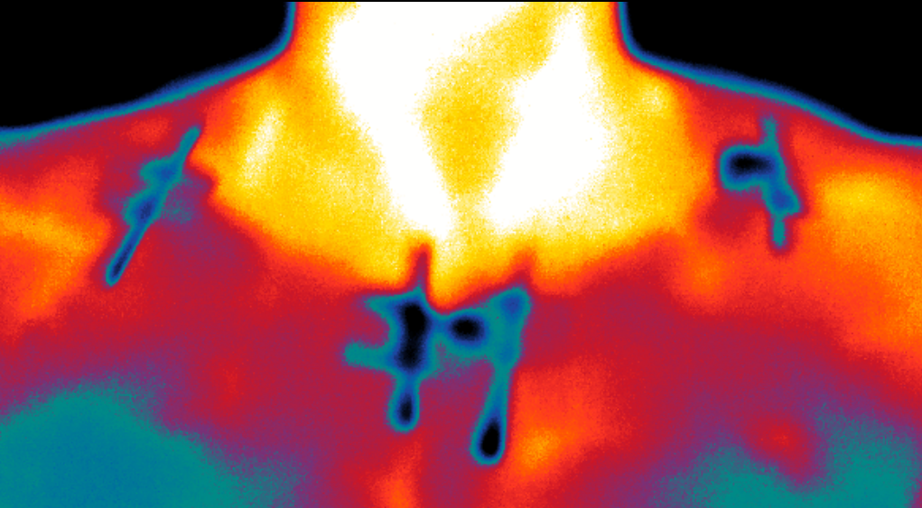 Et billede taget med infrarødt kamera bruges ofte som markør for brunt fedt aktivitet, da man kan måle overfladetemperaturen ovenover nøglebenet, hvor der er et stort depot af brunt fedt.  Billedet viser således også en højere varme i området (de brune og hvide områder). Dog skal det siges, at varmen også kan komme fra blodkar og omkringliggende muskler (foto: Mette Malene Motzfeldt Jensen).