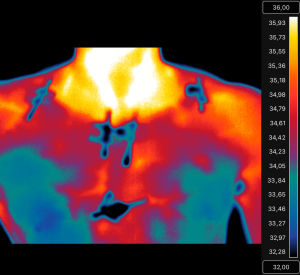 Et billede taget med infrarødt kamera bruges ofte som markør for brunt fedt aktivitet, da man kan måle overfladetemperaturen ovenover nøglebenet, hvor der er et stort depot af brunt fedt. Billedet viser således også en højere varme i området (de bruge og hvide områder). Dog skal det siges, at varmen også kan komme fra blodkar og omkringliggende muskler (foto: Mette Malene Motzfeldt Jensen).