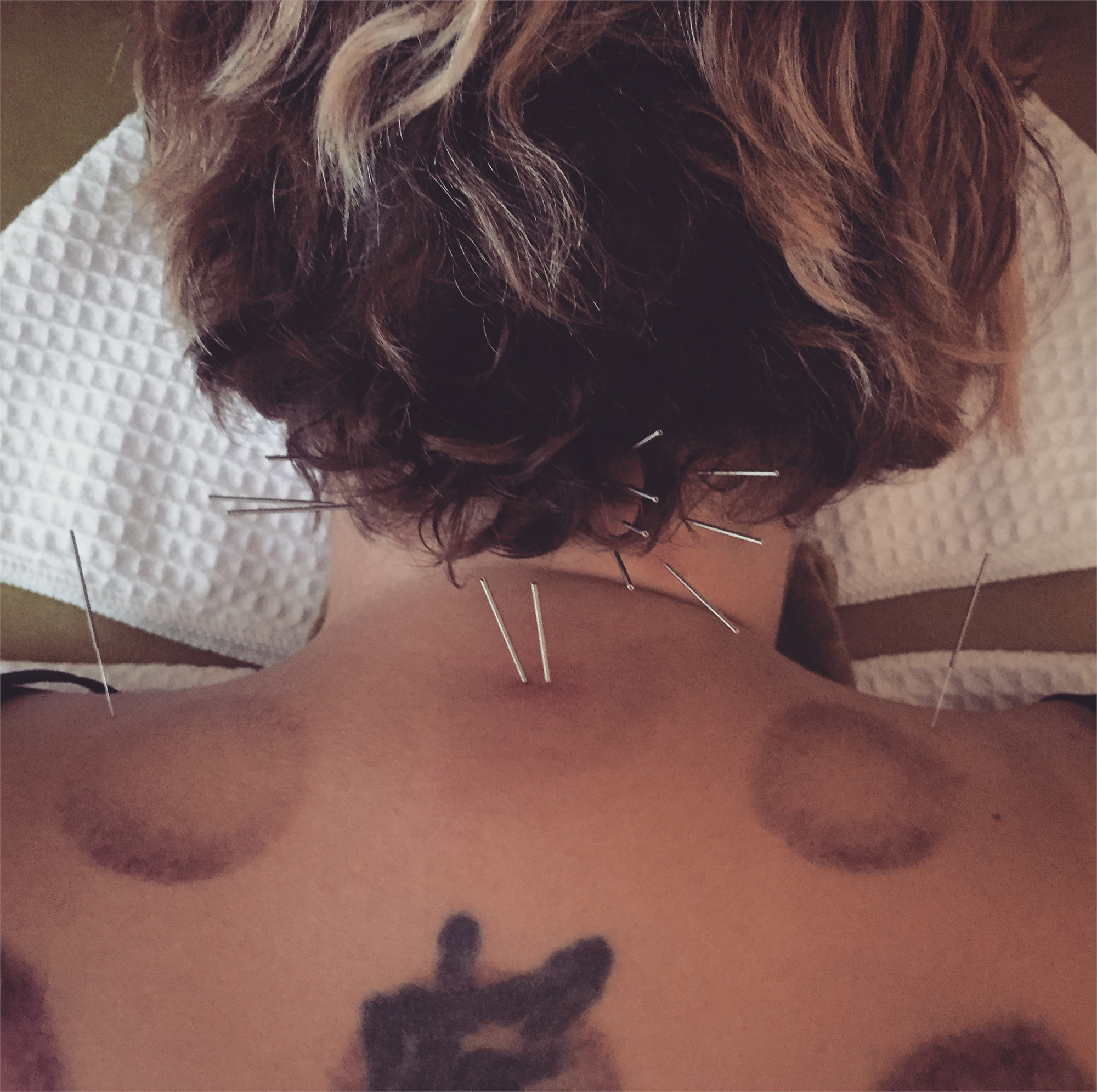acupuncture on a womans neck and back