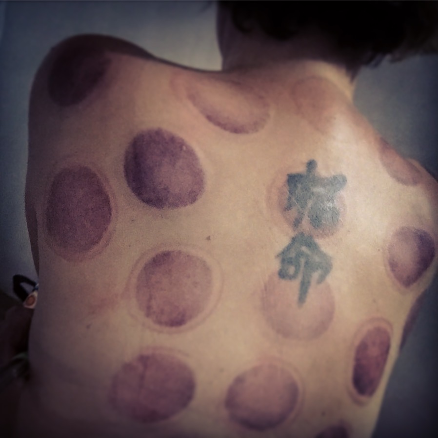after cupping on a woman's back