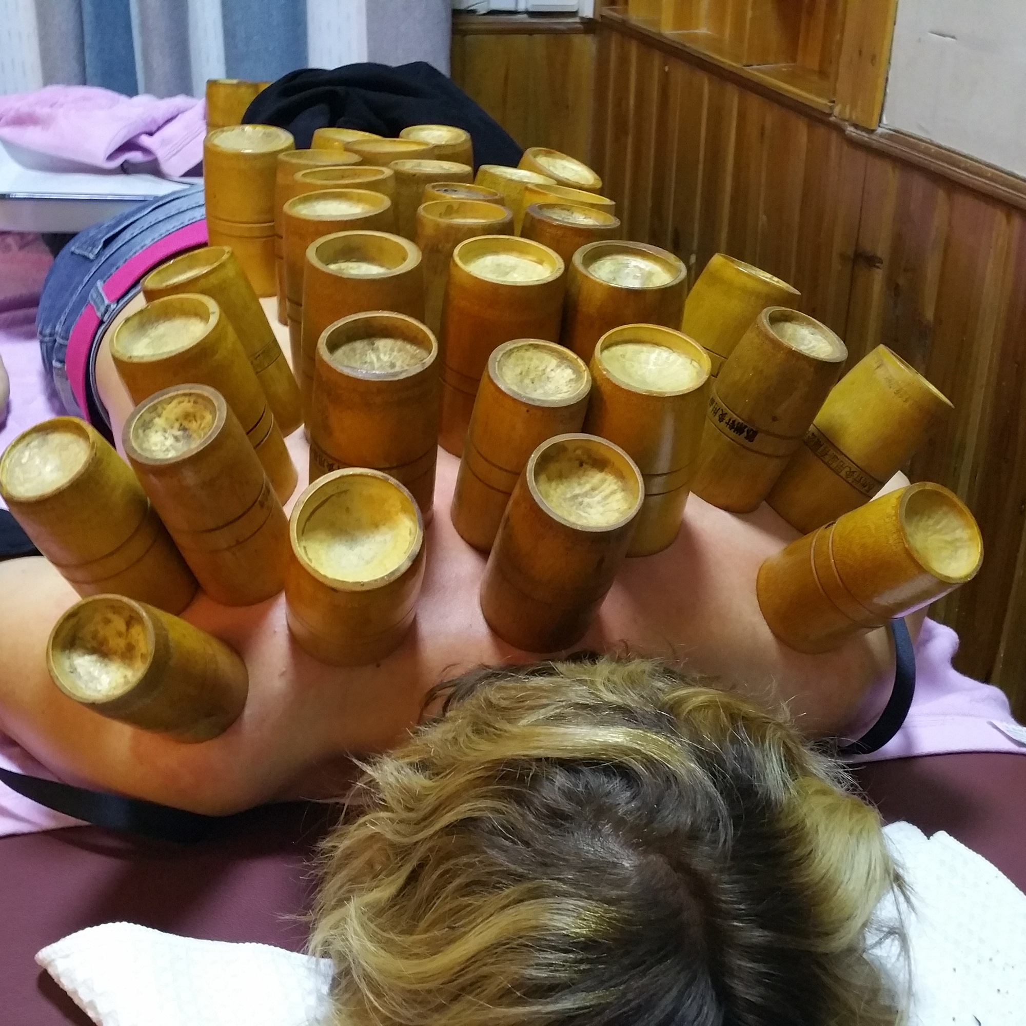 cupping on a woman's back