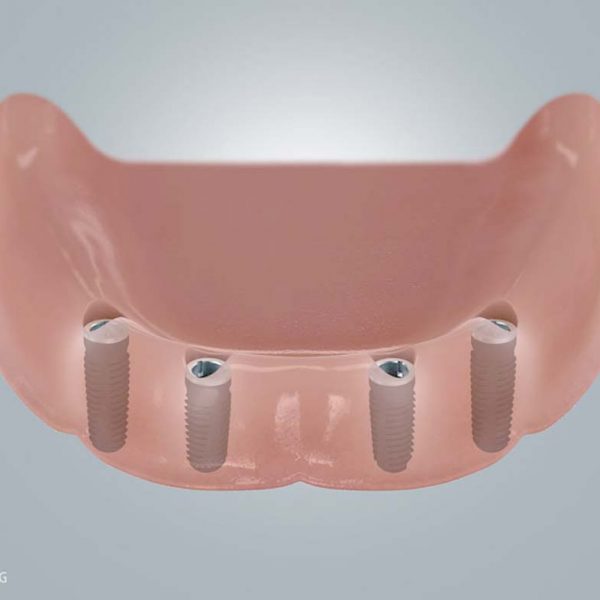 Zahnersatz Unterkiefer