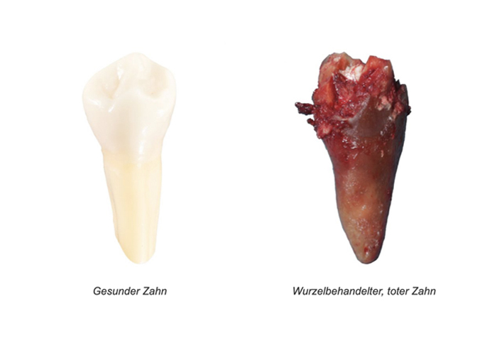 Vergleich eines gesunden und eines toten Zahnes