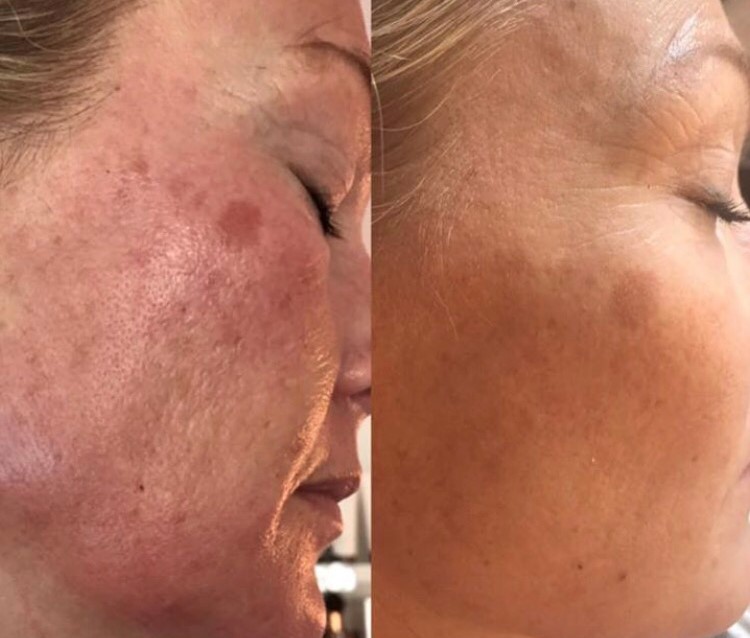 Microneedle før og efter