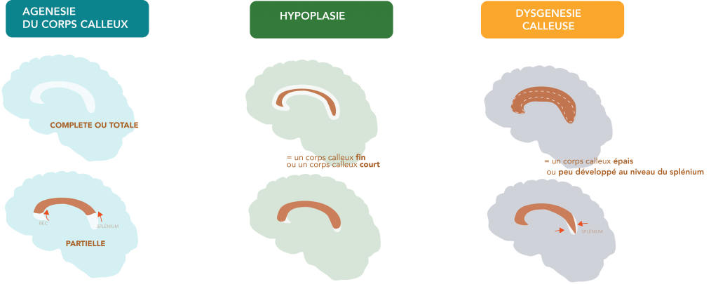 Les Anomalies Du Corps Calleux Association Raccord