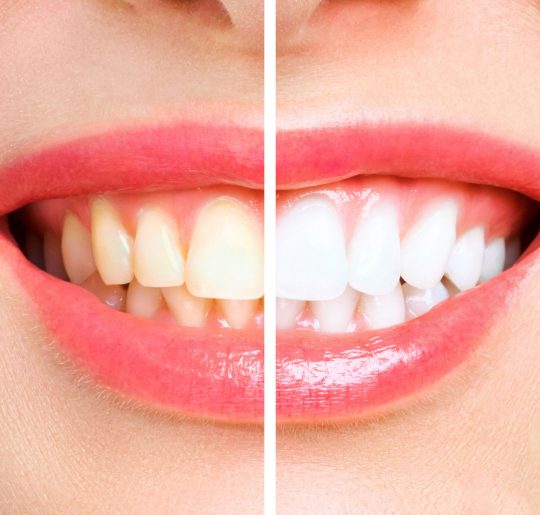 woman teeth before and after whitening. Over white background. Dental clinic patient. Image symbolizes oral care dentistry, stomatology.