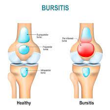 Exercises for Bursitis of the Knee