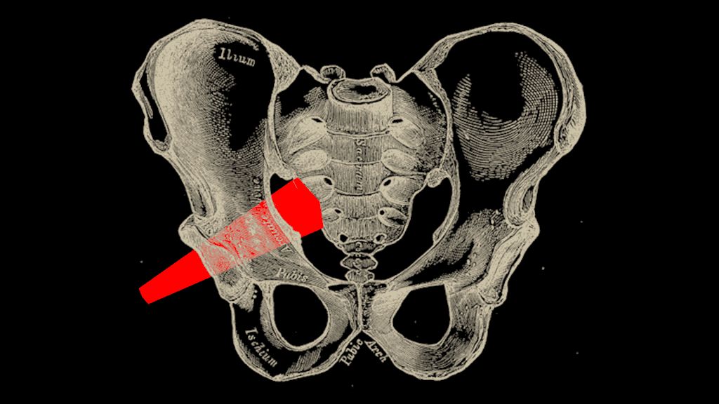 M. Piriformis: Kleiner Muskel - große Probleme 1