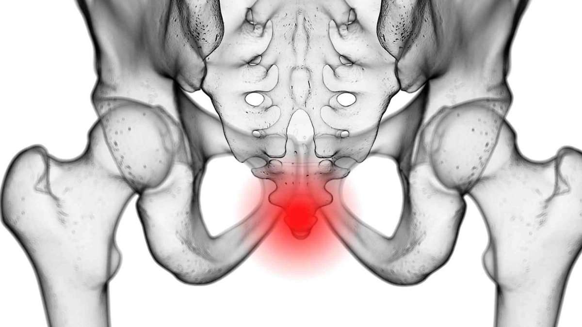 Schmerzen am Steissbein Coccygodynie