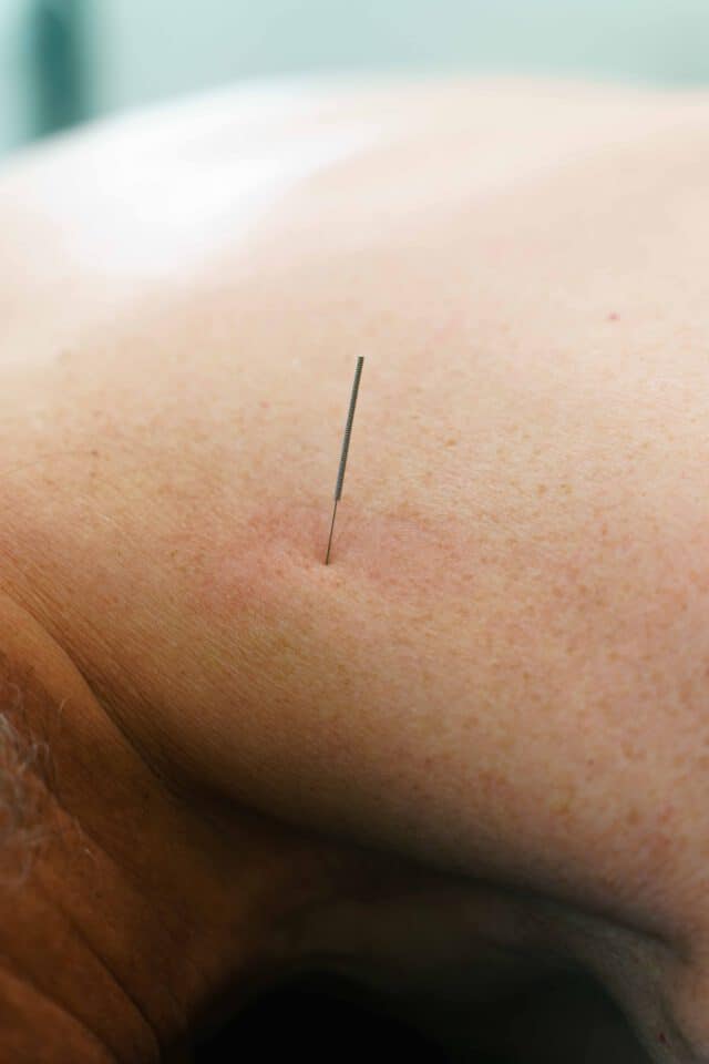 Dry needling in de schouder