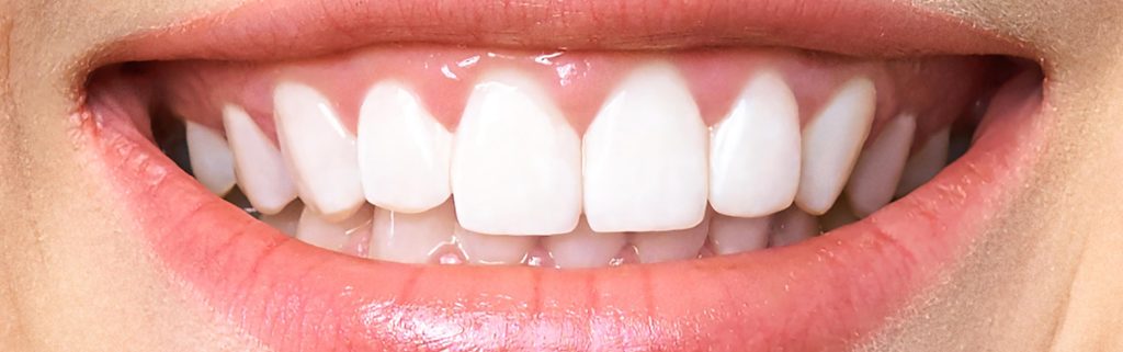 after whitening