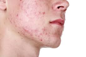 Spotty Teen Homeopathy for Acne