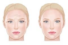 Graphic of a blonde woman before and after using anti aging products. Her crow`s feet and wrinkles dissapered.