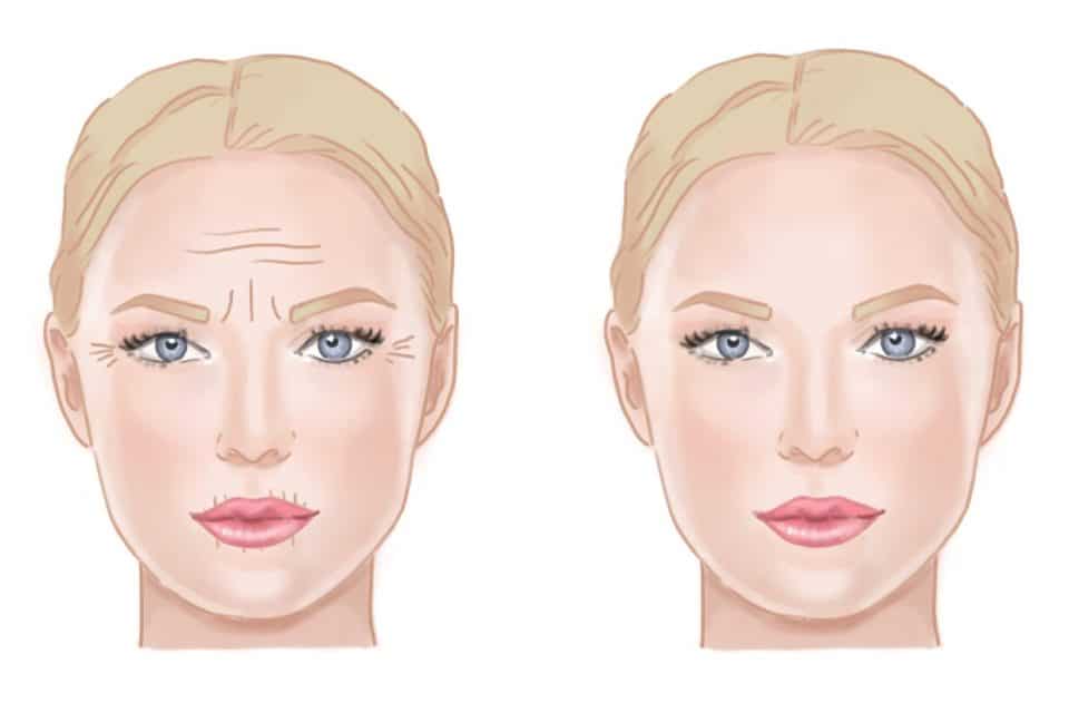 Graphic of a blonde woman before and after using anti aging products. Her crow`s feet and wrinkles dissapered.