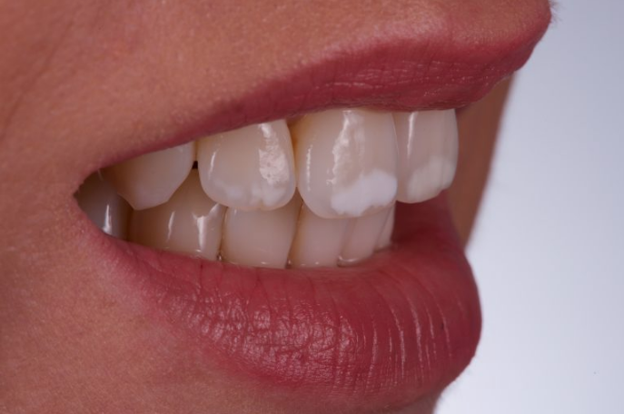 ICON Behandling voor verwijderen witte vlekken bij Royal Blue Dental