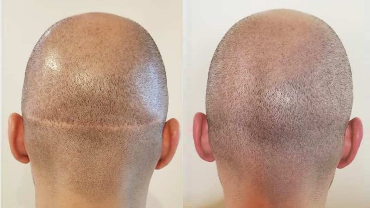 Scalp Micropigmentering för Ärr