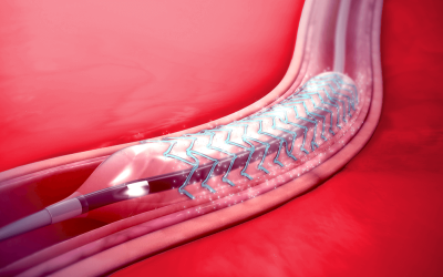 Safe Stents and Implants