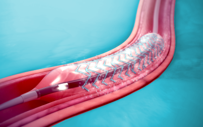 Compliant Stents