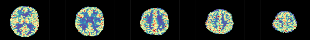 cerebrovascular reactivity (CVR) map, hemodynamic lag map, MRI hypercapnia hyperoxia BOLD HRF