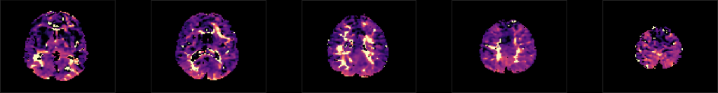 cerebrovascular reactivity (CVR) map, hemodynamic lag map, MRI hypercapnia hyperoxia BOLD HRF