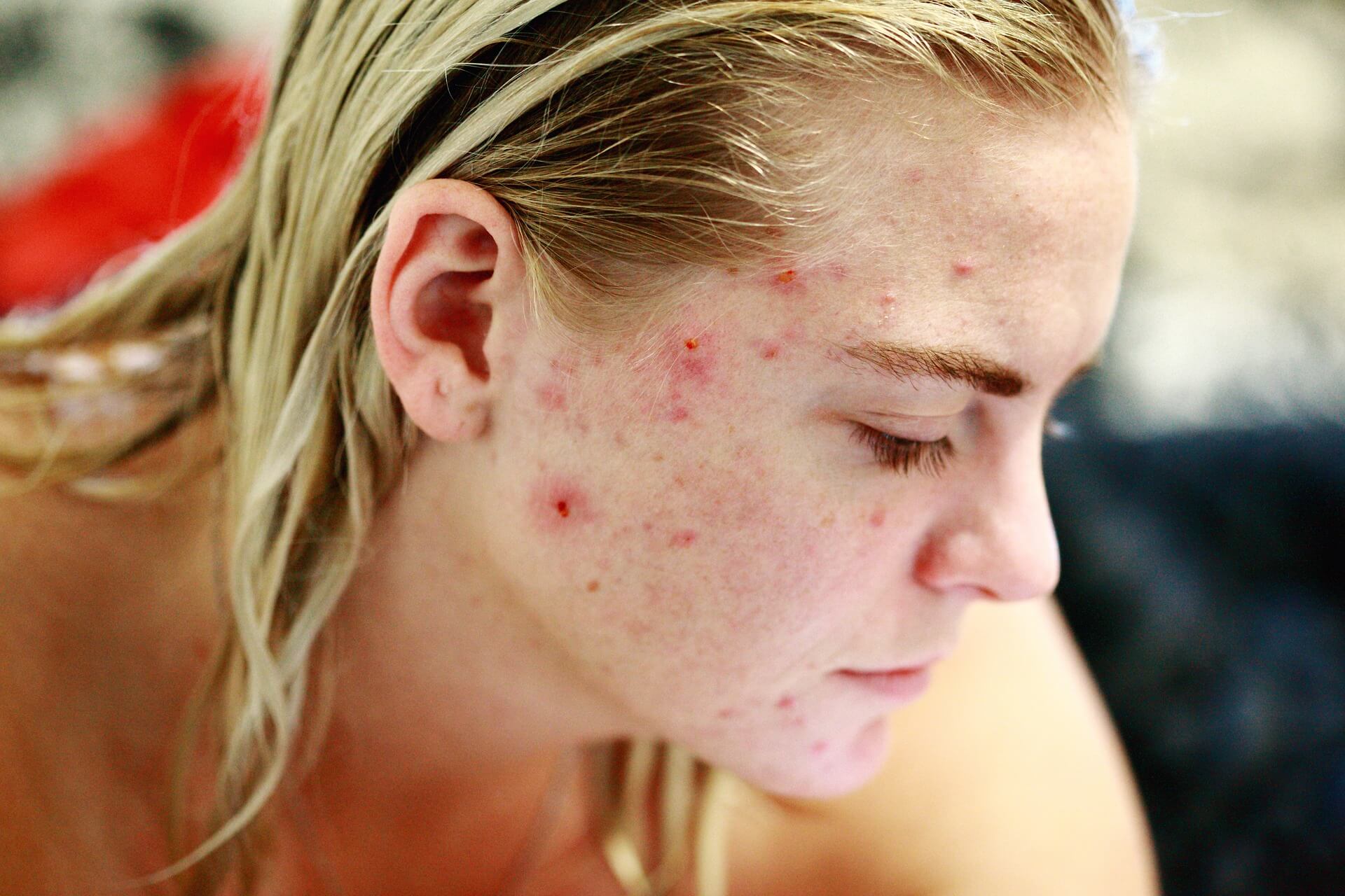 Can a Food Sensitivity Test Help my Acne