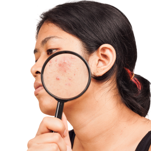 Acne-Prone Skin