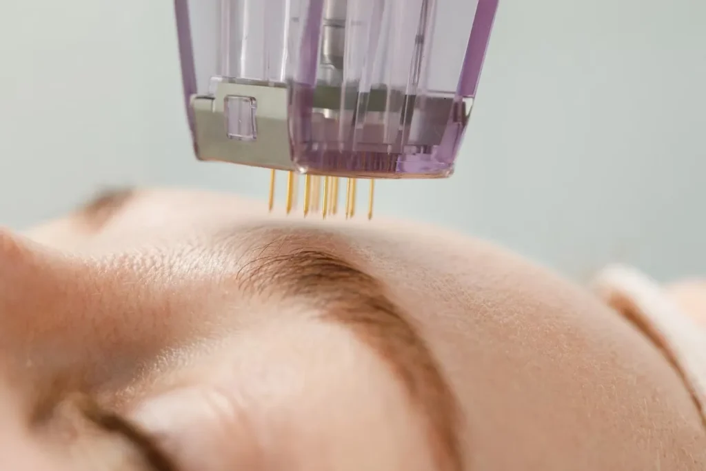 Kvinna får behandling med microneedling