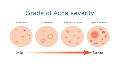 grade of acne severity