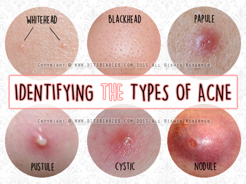 identifying types of acne