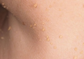 Fibrom