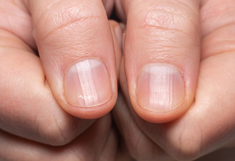 naglar skivar sig vitaminbrist