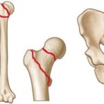 osteoporosis fractures