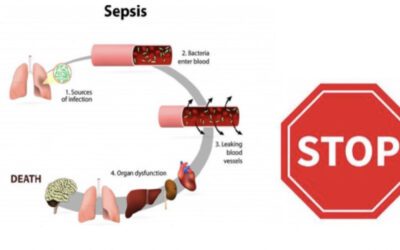 Sepsis voorspellen op basis van klinische parameters