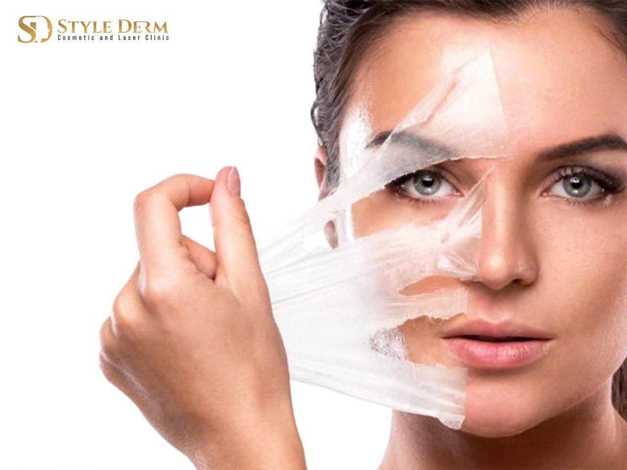 Kemisk peeling