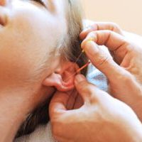 kvinde som modtager øre akupunktur imod stress