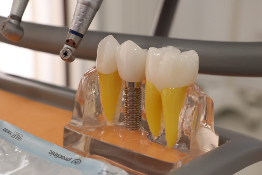 Implantes dentales en El Casar